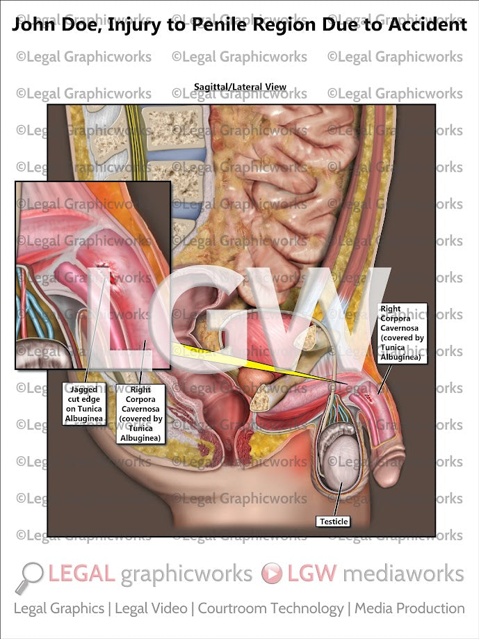 Injury to Penile Region Due to Accident