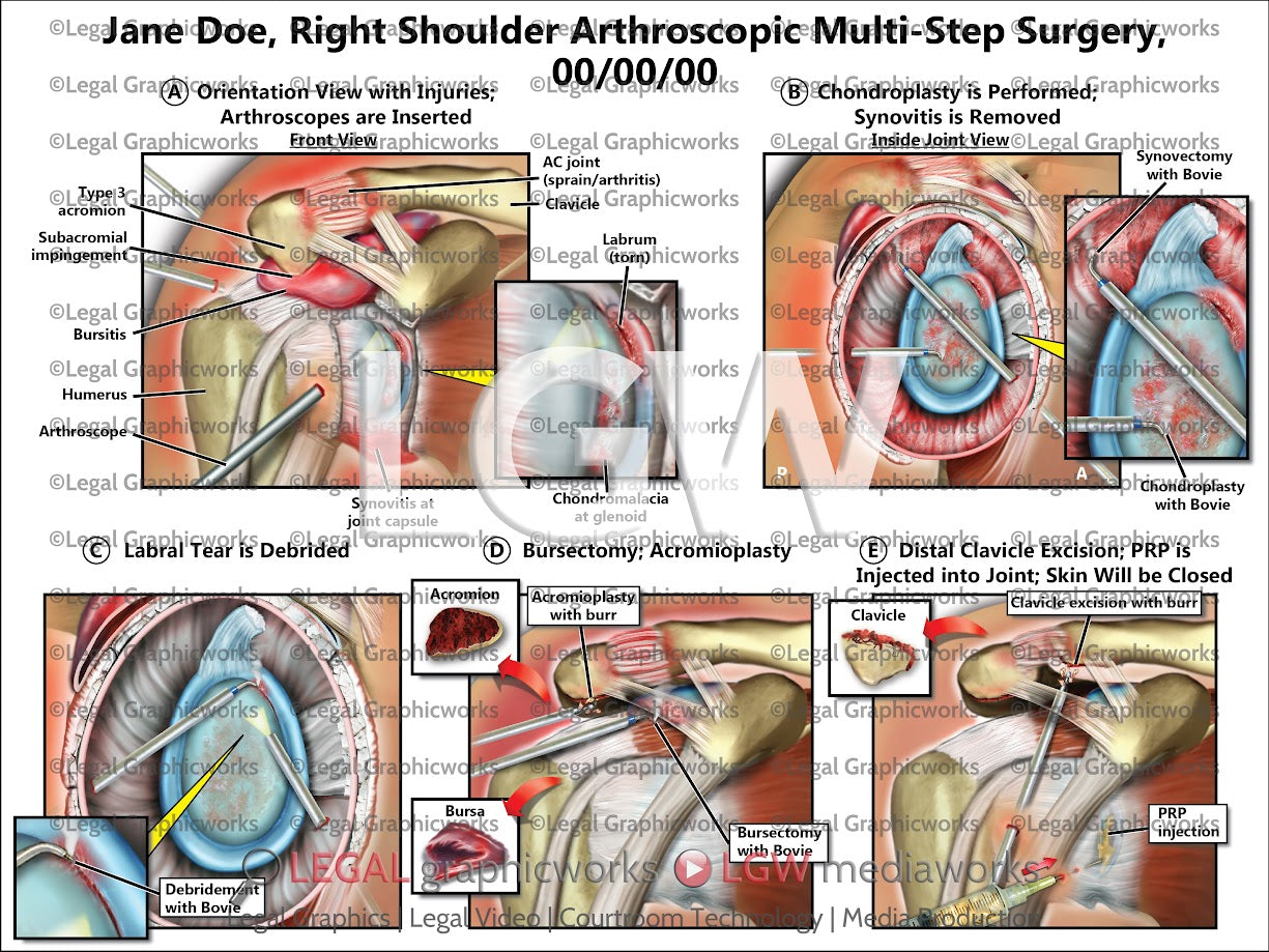 Right Shoulder Arthroscopic Multi-Step Surgery