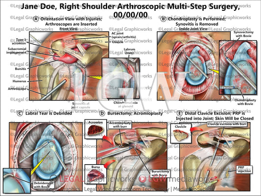 Right Shoulder Arthroscopic Multi-Step Surgery