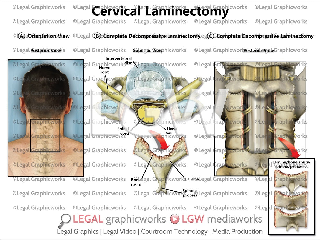 Cervical Laminectomy
