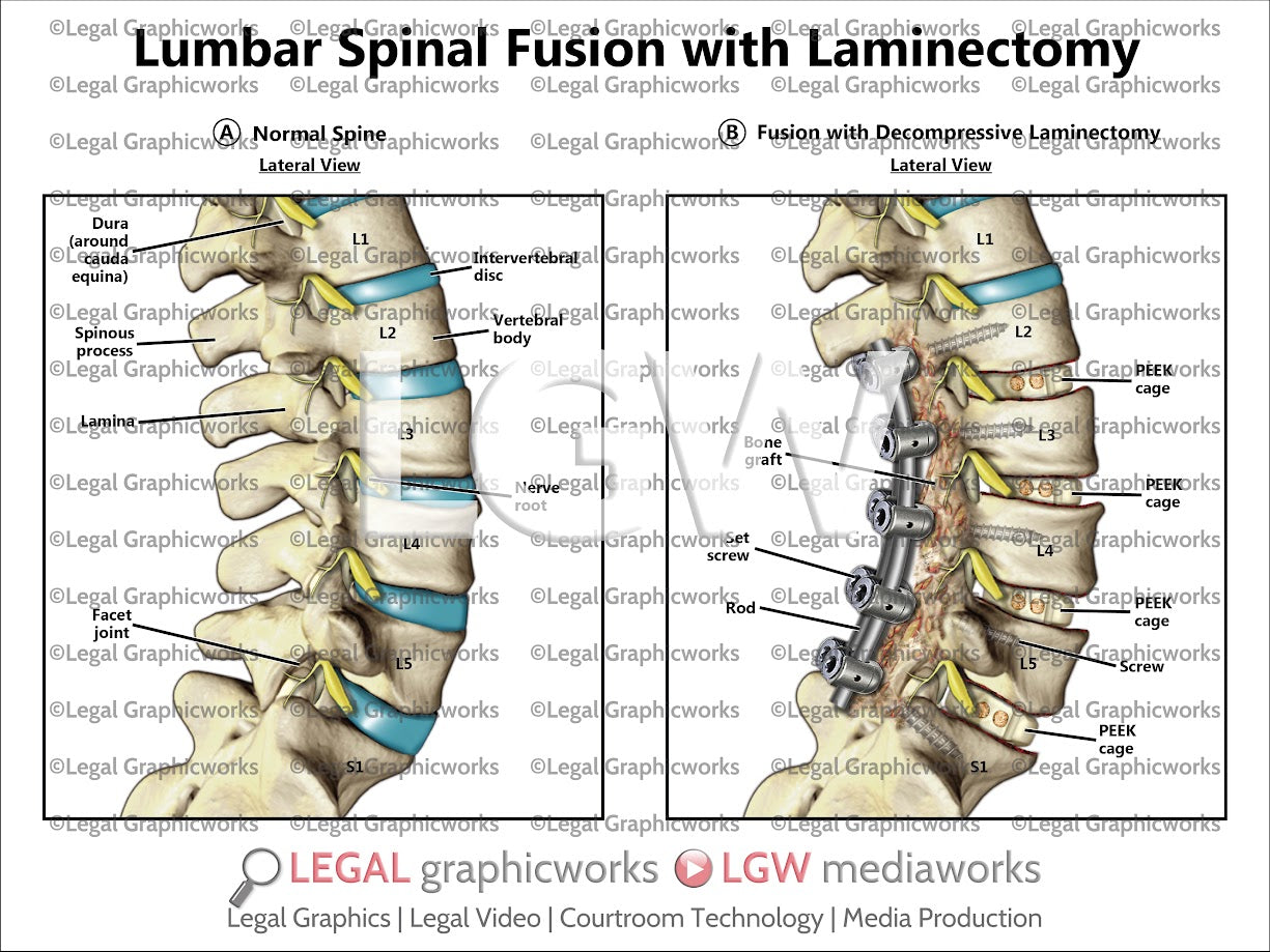 Lumbar Spinal Fusion with Laminectomy