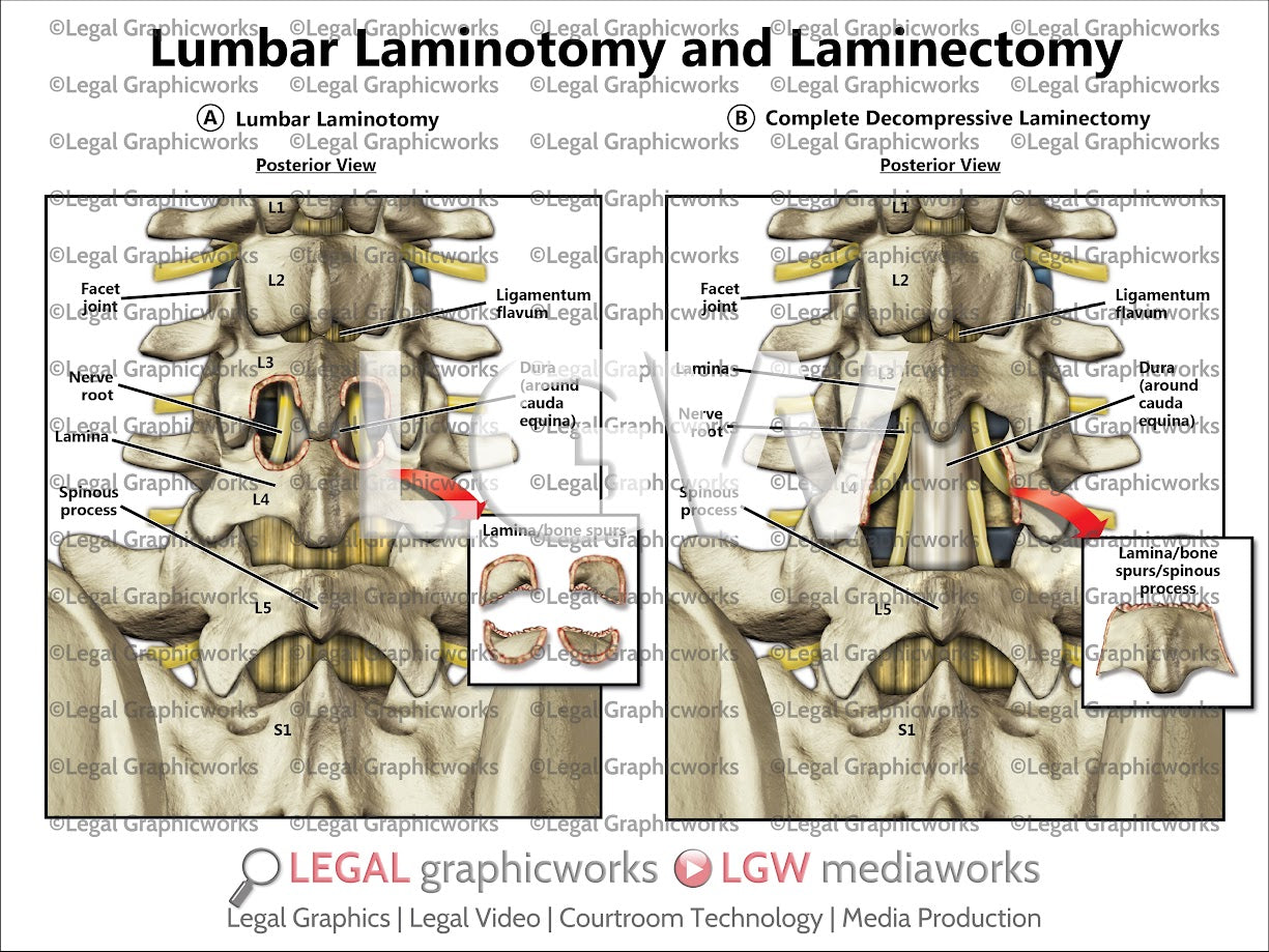Lumbar Laminotomy and Laminectomy