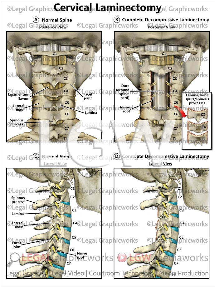 Cervical Laminectomy