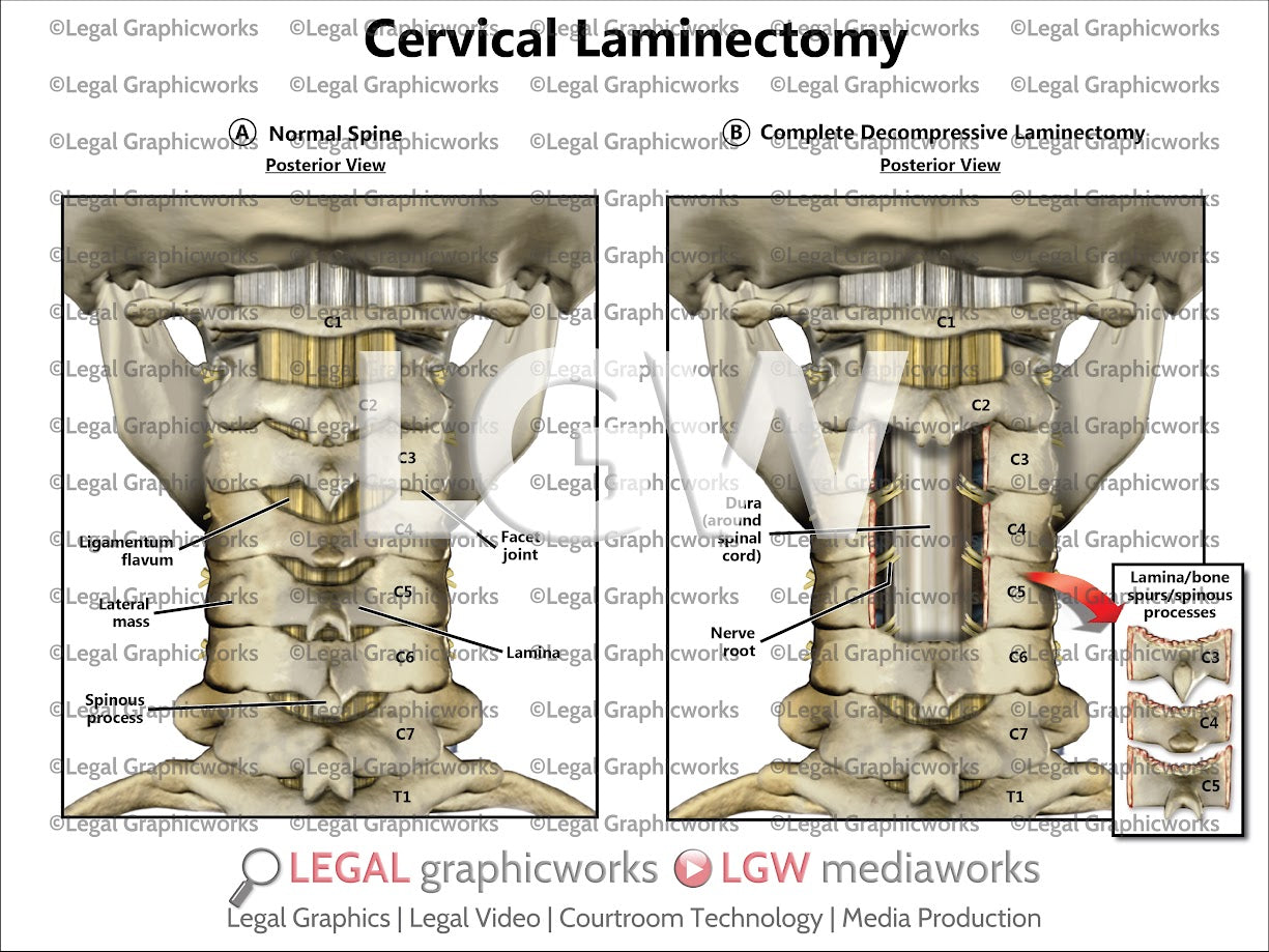 Cervical Laminectomy