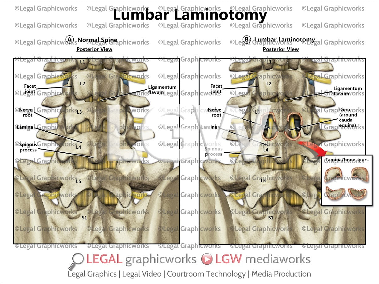 Lumbar Laminotomy