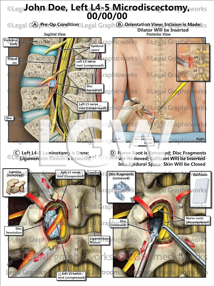 Left L4-5 Microdiscectomy