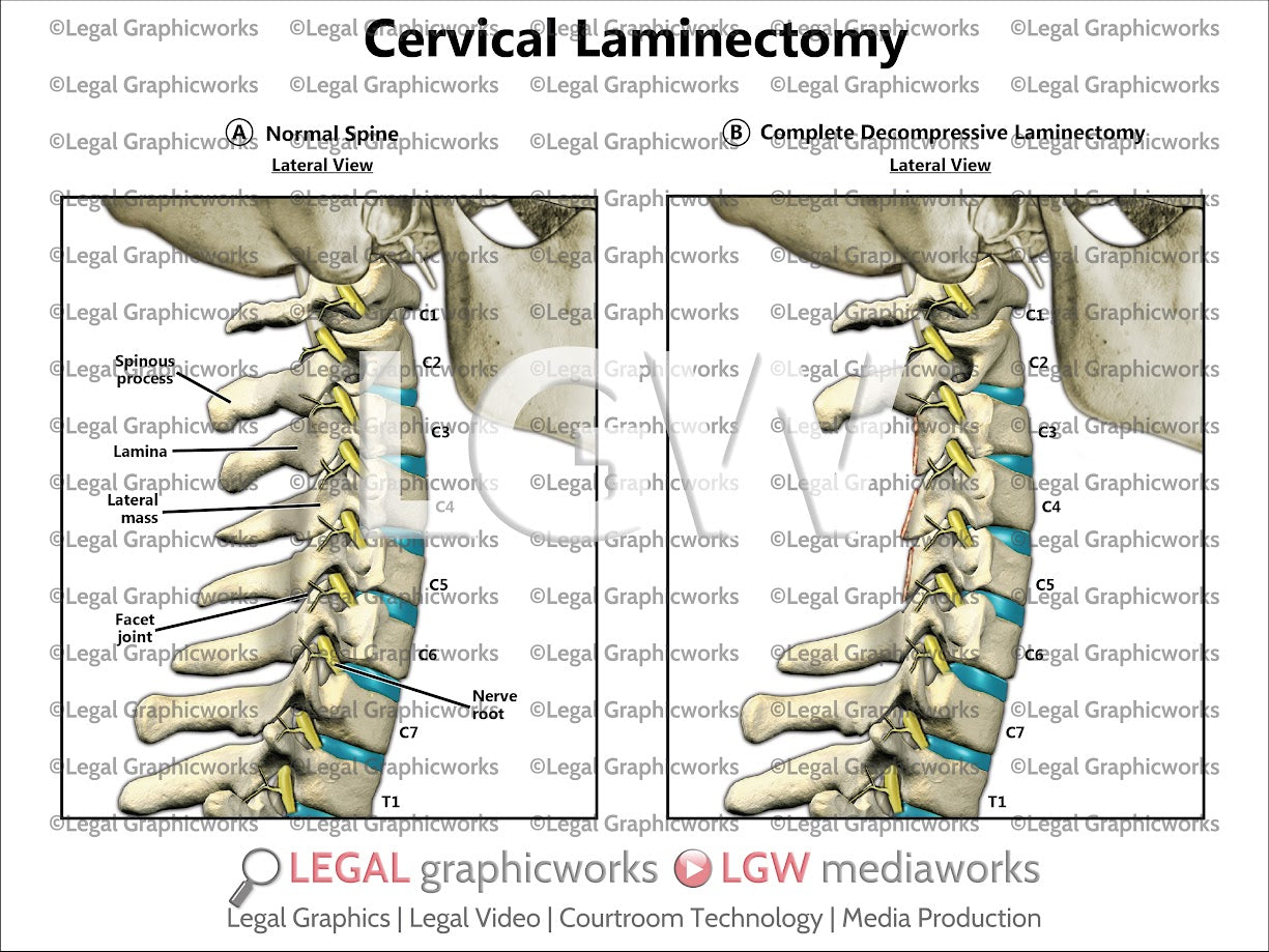 Cervical Laminectomy
