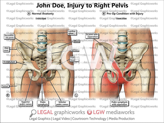 Injury to Right Pelvis