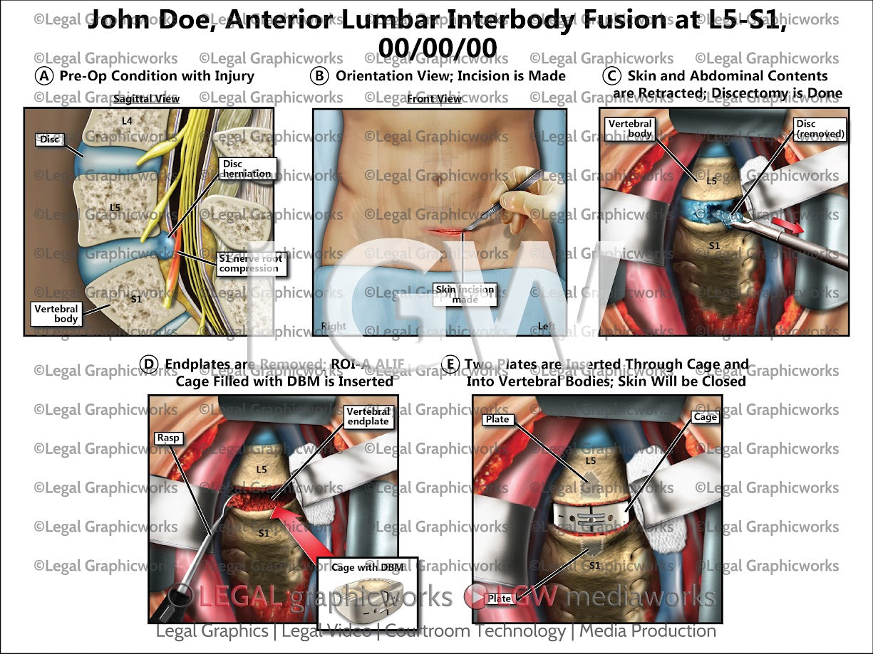 Anterior Lumbar Interbody Fusion at L5-S1