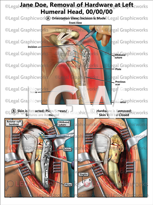 Removal of Hardware at Left Humeral Head