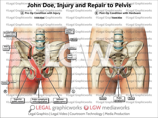 Injury and Repair to Pelvis
