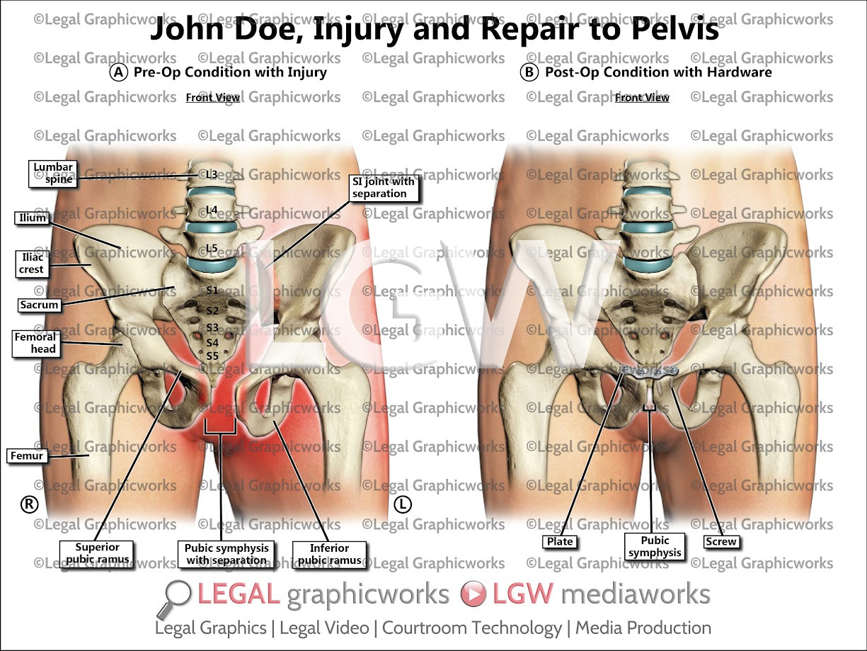Injury and Repair to Pelvis