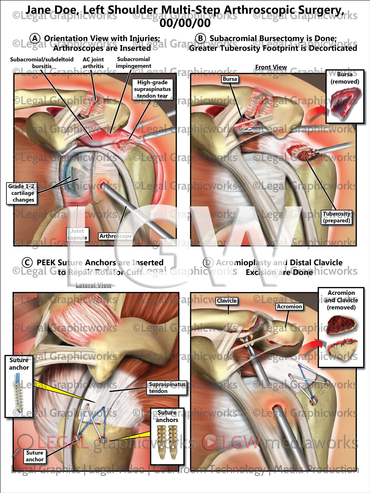 Left Shoulder Multi-Step Arthroscopic Surgery