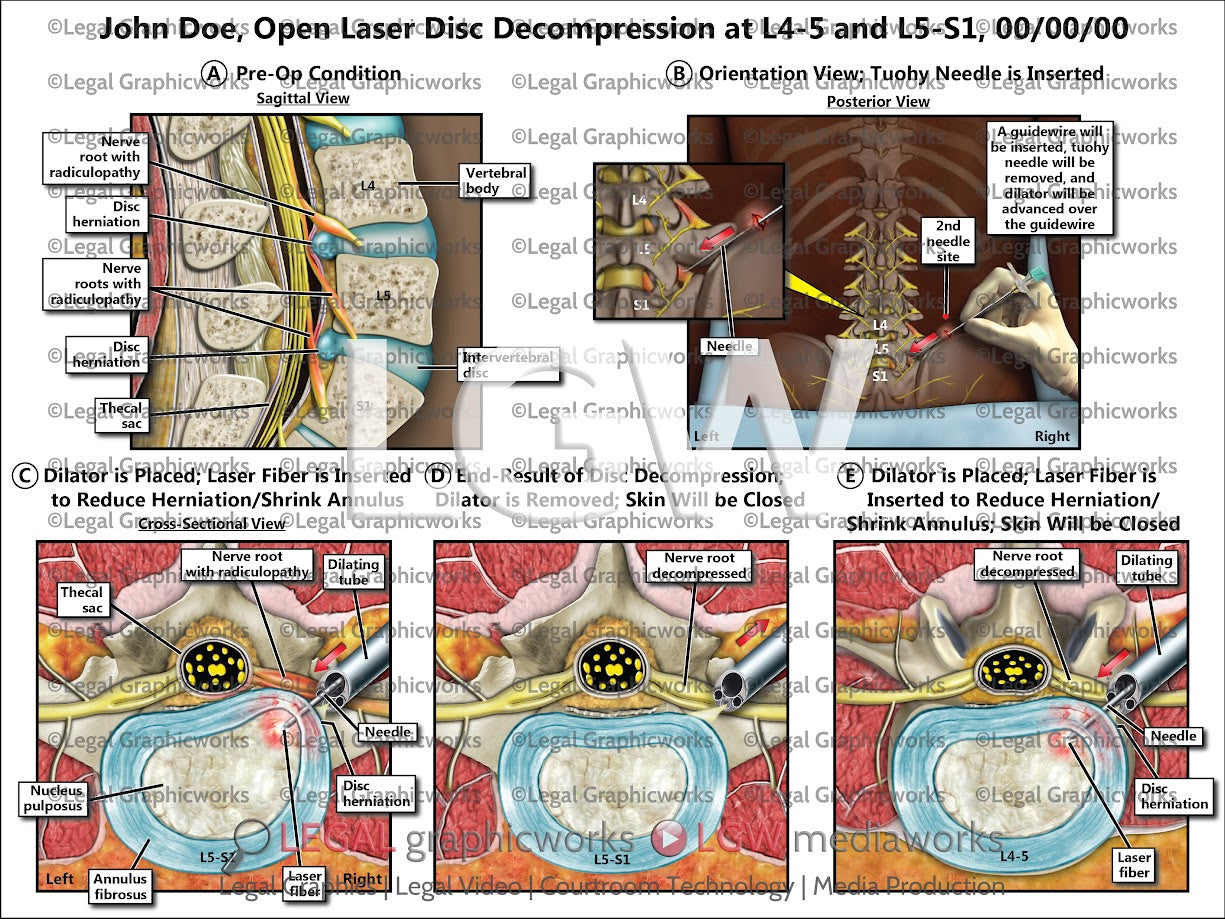 Open Laser Disc Decompression at L4-5 and L5-S1