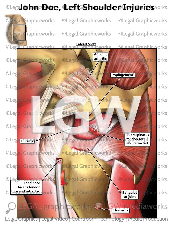 Left Shoulder Injuries