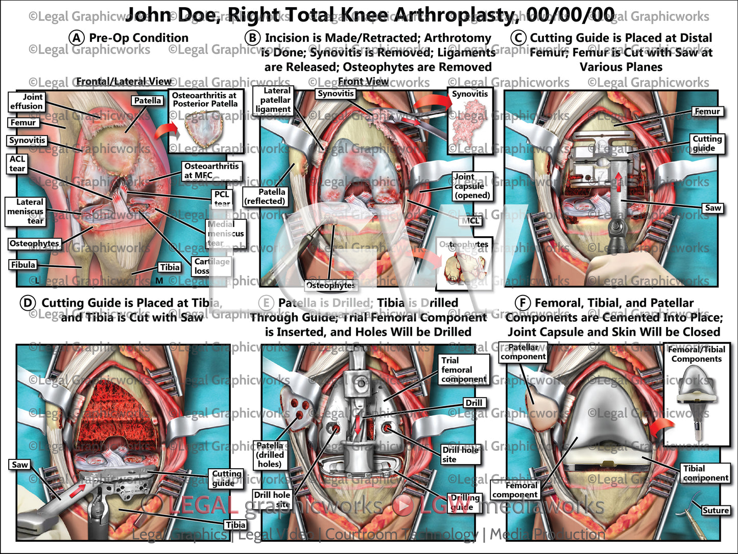Right Total Knee Arthroplasty