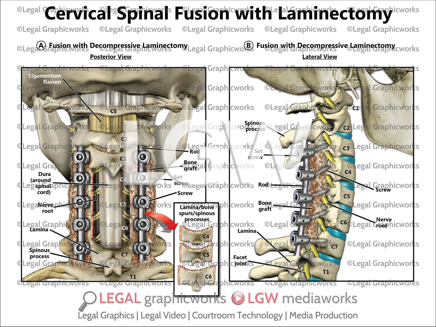 Cervical Spinal Fusion with Laminectomy