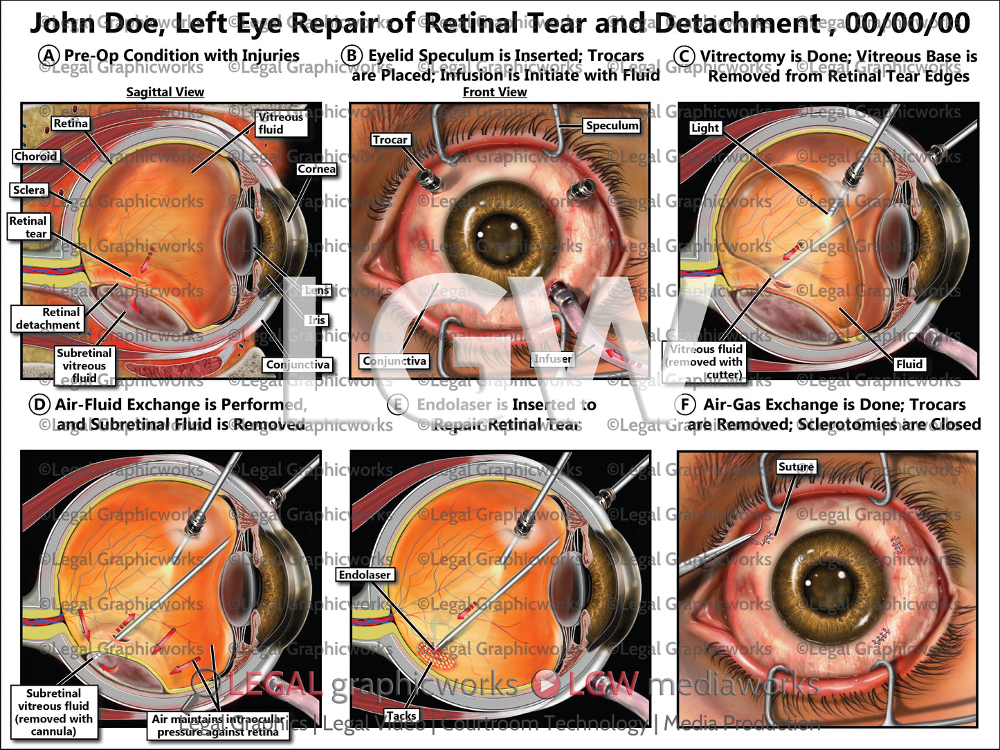Left Eye Repair of Retinal Tear and Detachment