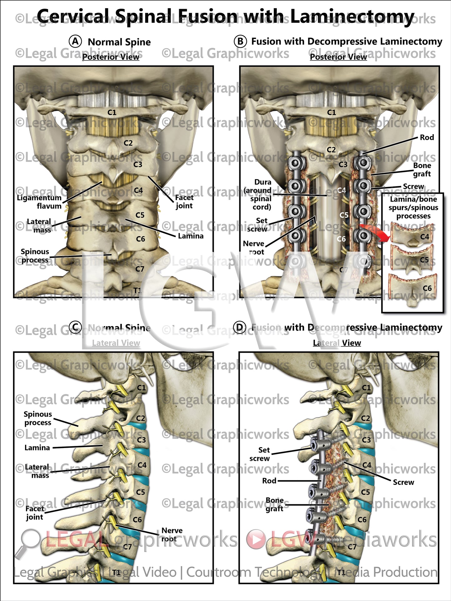 Cervical Spinal Fusion with Laminectomy