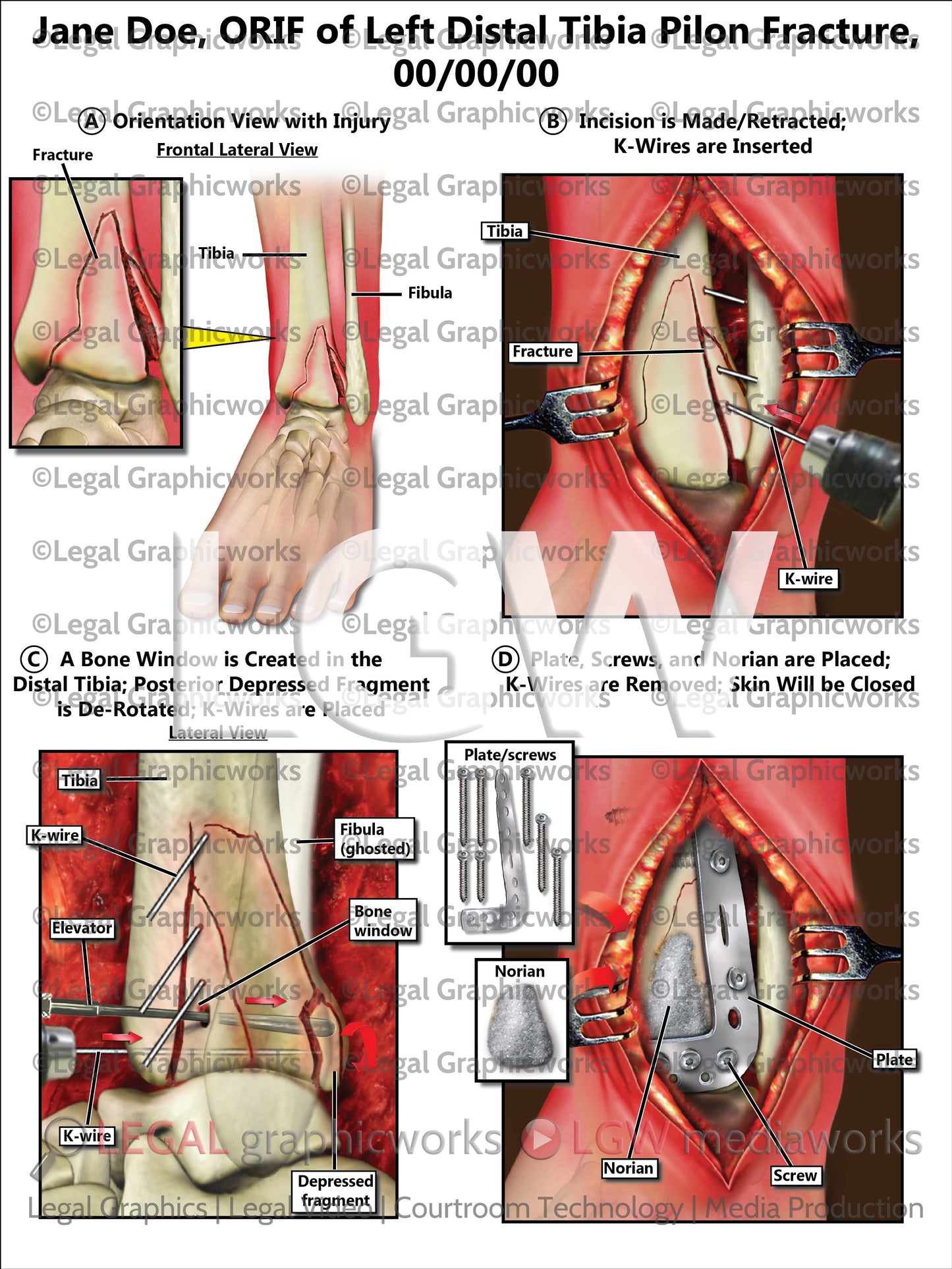 ORIF of Left Distal Tibia Pilon Fracture