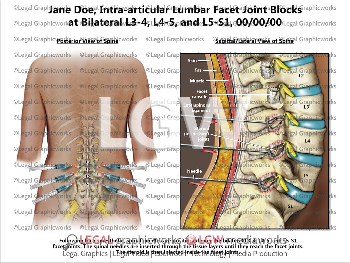 Intra-articular Lumbar Facet Joint Blocks at Bilateral L3-4, L4-5, and L5-S1