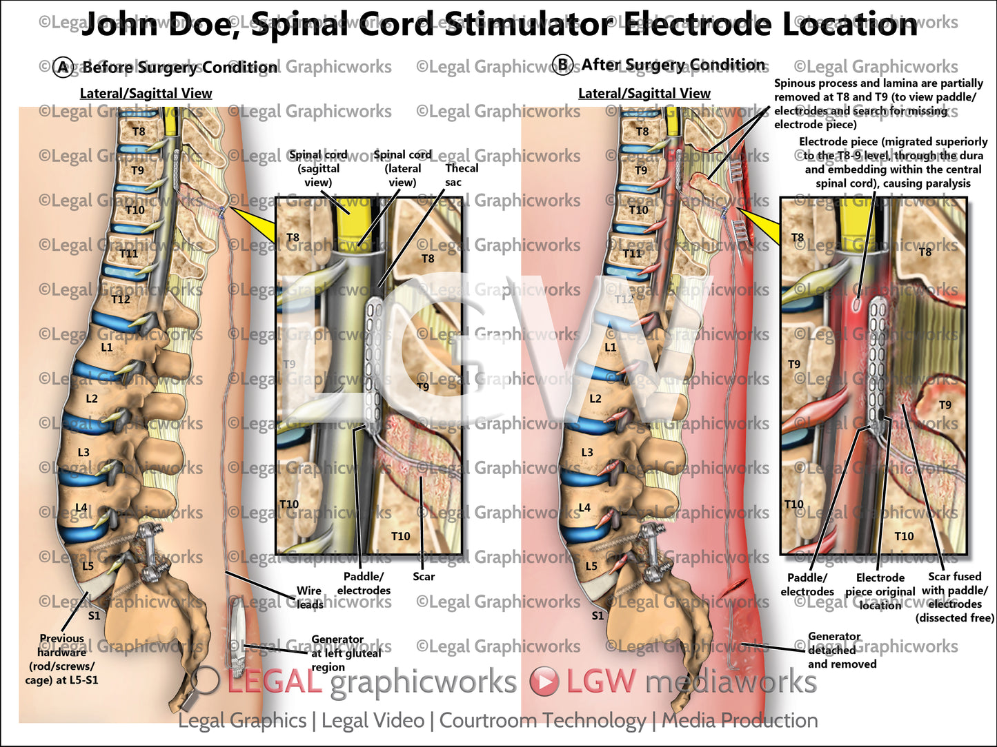 Spinal Cord Stimulator Electrode Location
