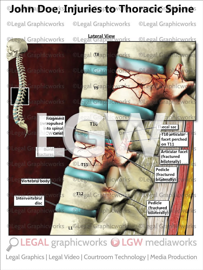 Injuries to Thoracic Spine
