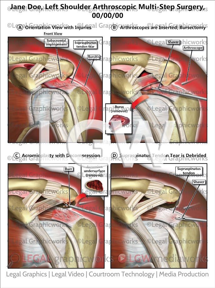 Left Shoulder Arthroscopic Multi-Step Surgery