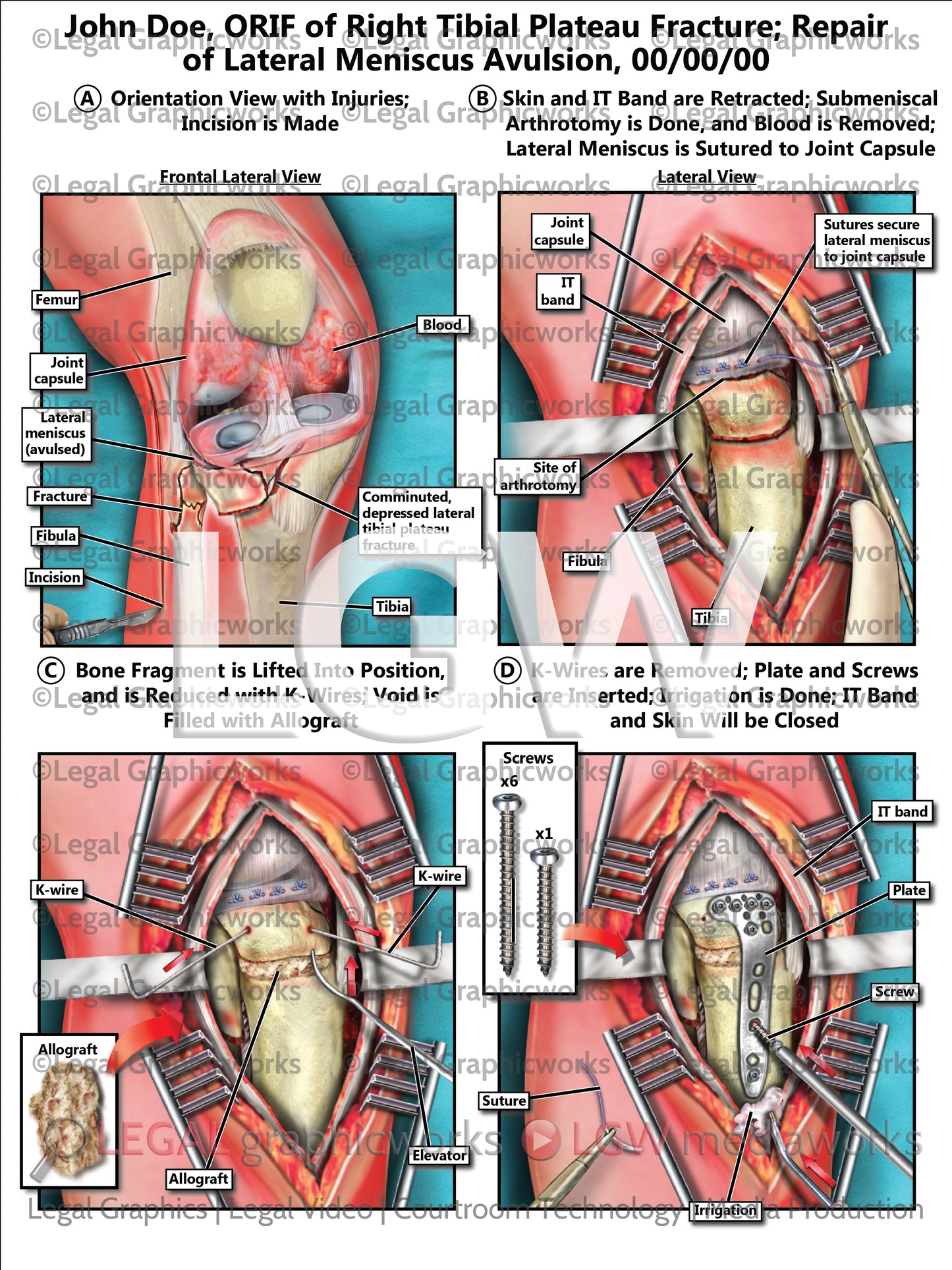 ORIF of Right Tibial Plateau Fracture; Repair of Lateral Meniscus Avulsion