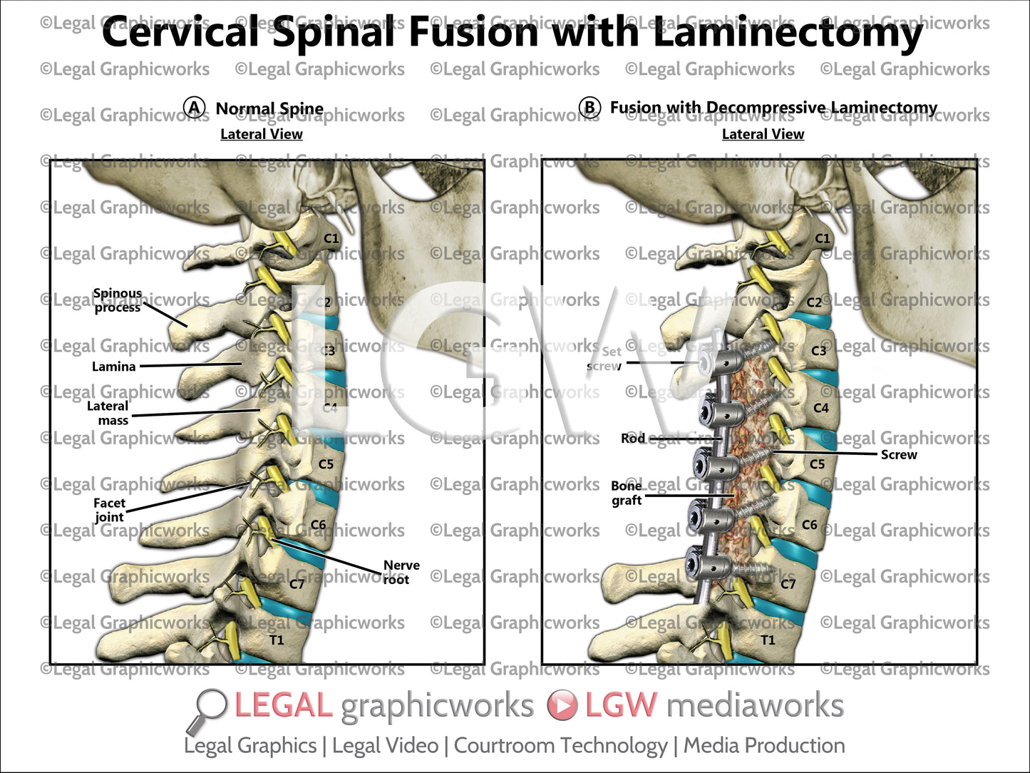 Cervical Spinal Fusion with Laminectomy