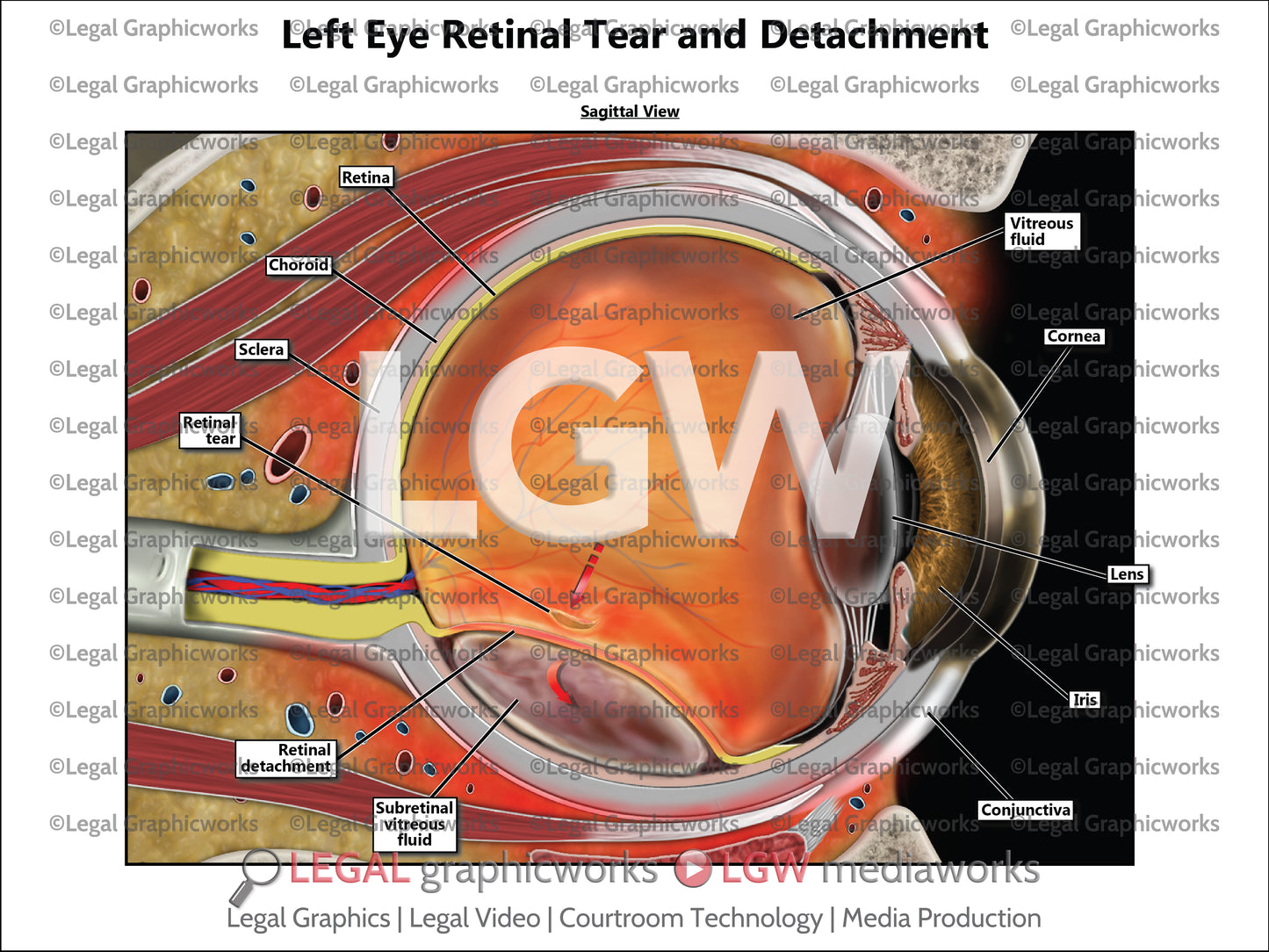 Left Eye Retinal Tear and Detachment