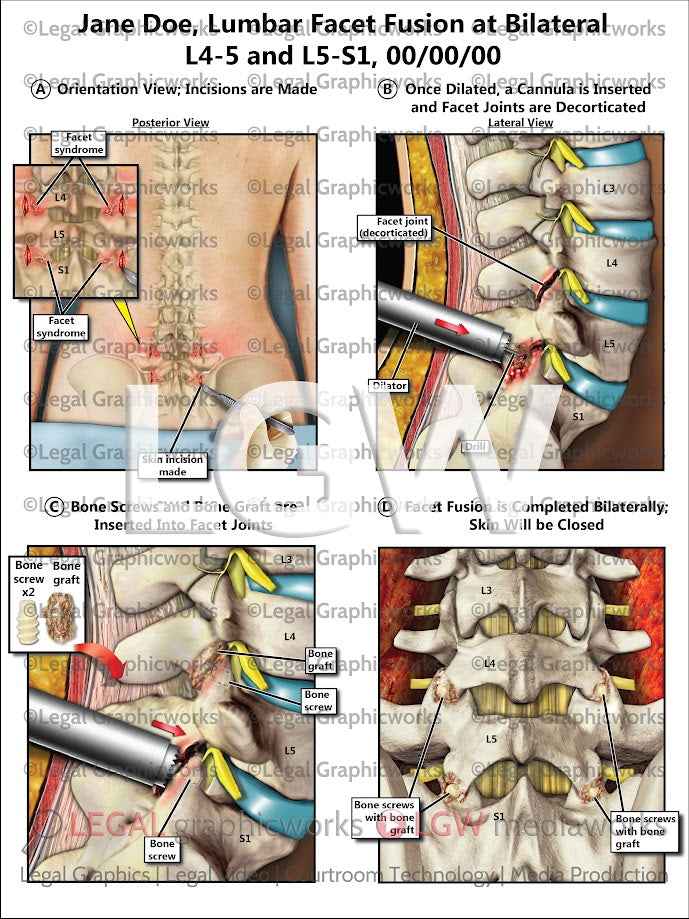 Lumbar Facet Fusion at Bilateral L4-5 and L5-S1