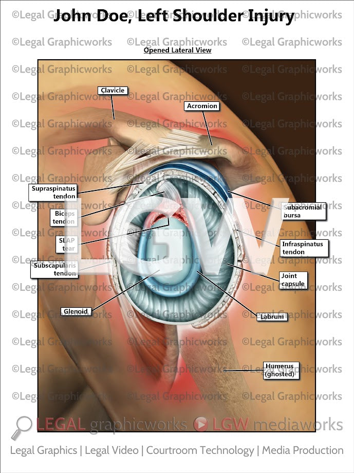 Left Shoulder Injury