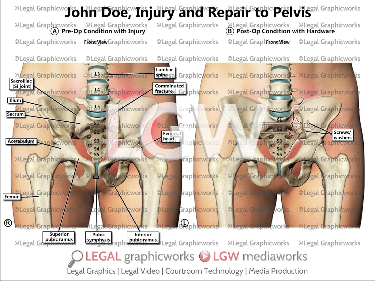 Injury and Repair to Pelvis