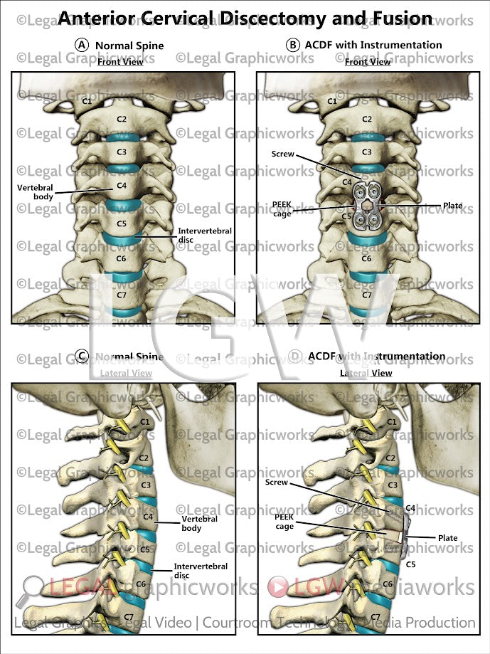 Anterior Cervical Discectomy and Fusion