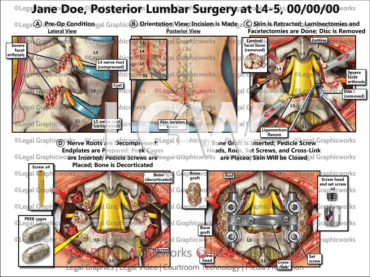 Posterior Lumbar Surgery at L4-5