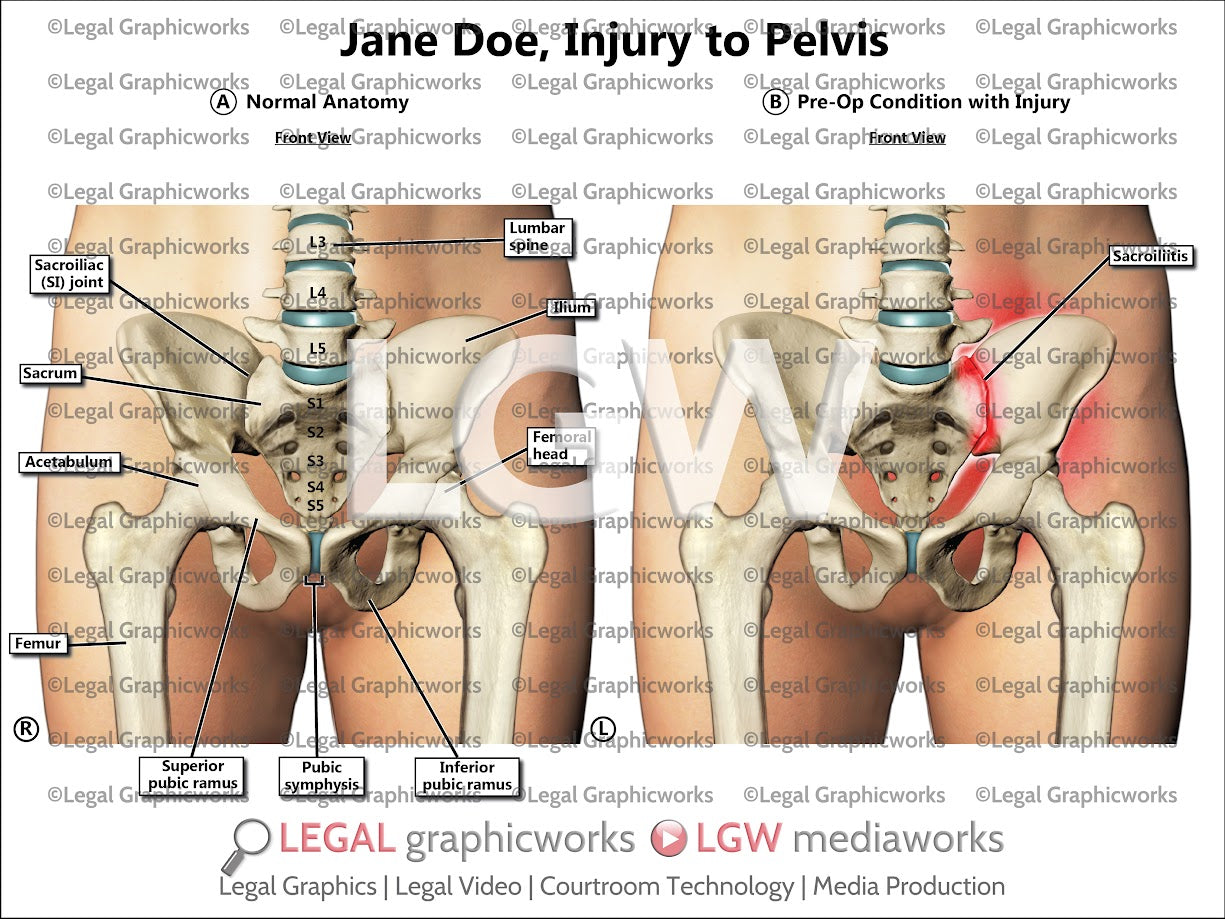 Injury to Pelvis