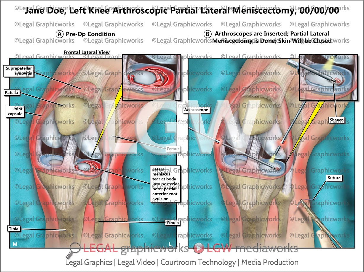 Left Knee Arthroscopic Partial Lateral Meniscectomy