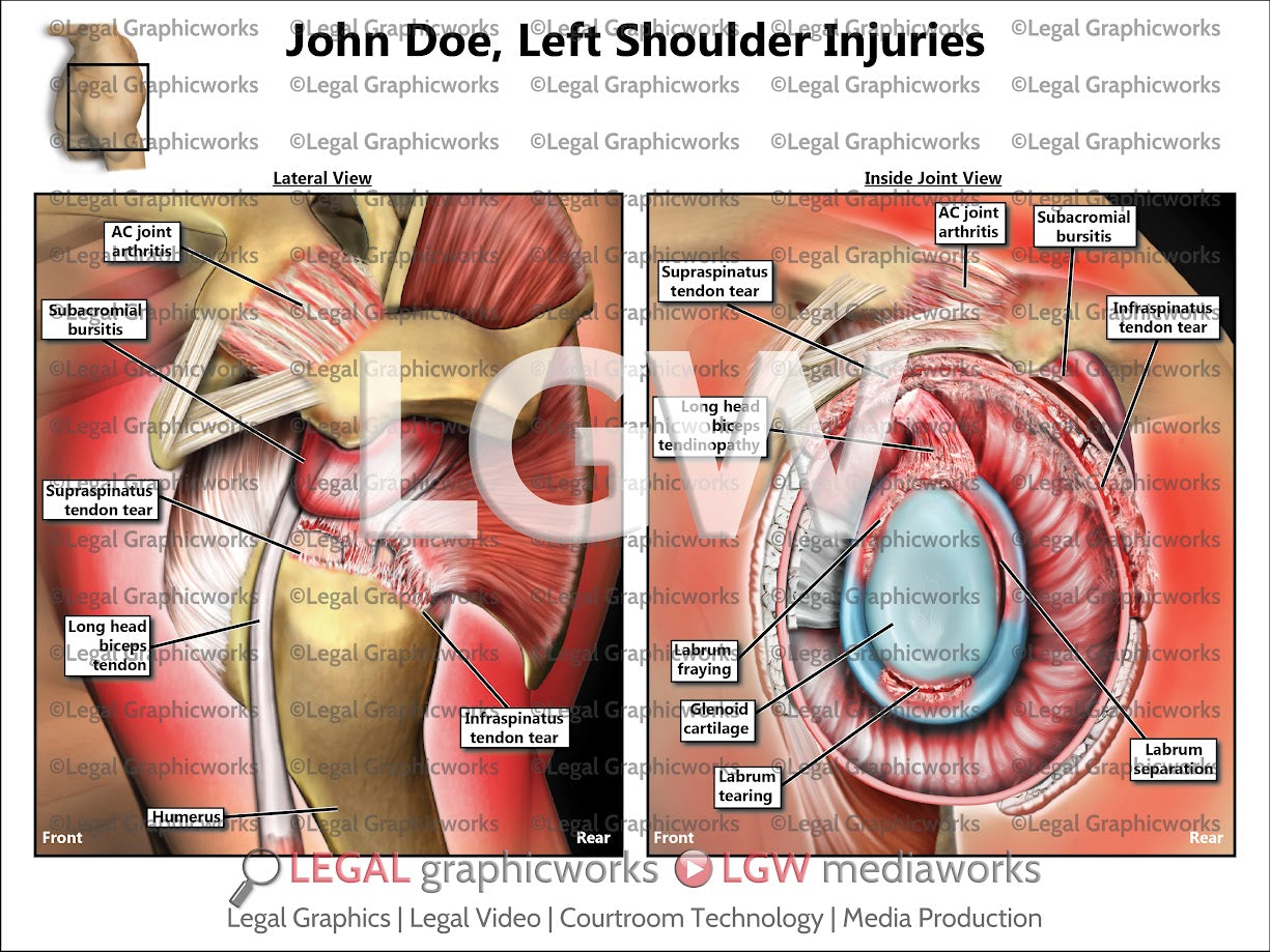 Left Shoulder Injuries