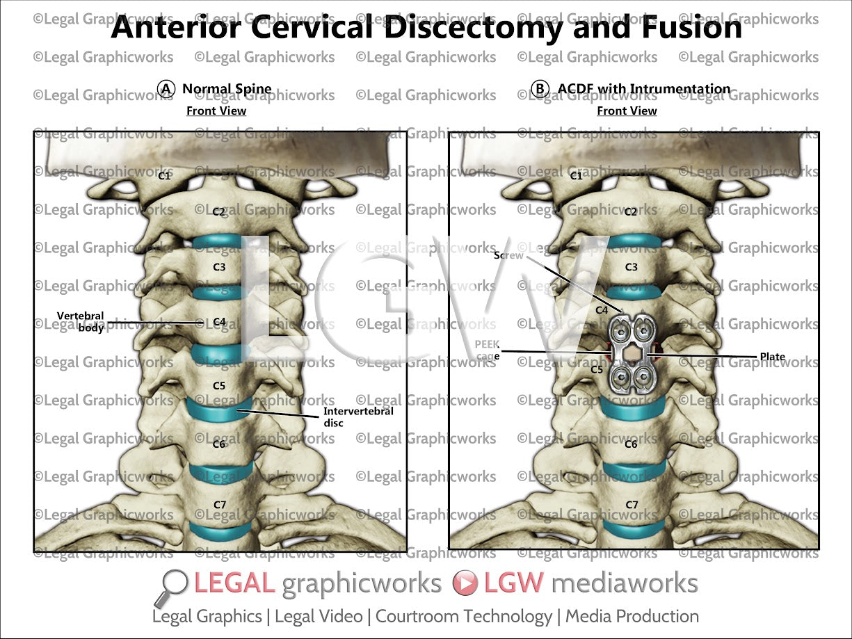 Anterior Cervical Discectomy and Fusion