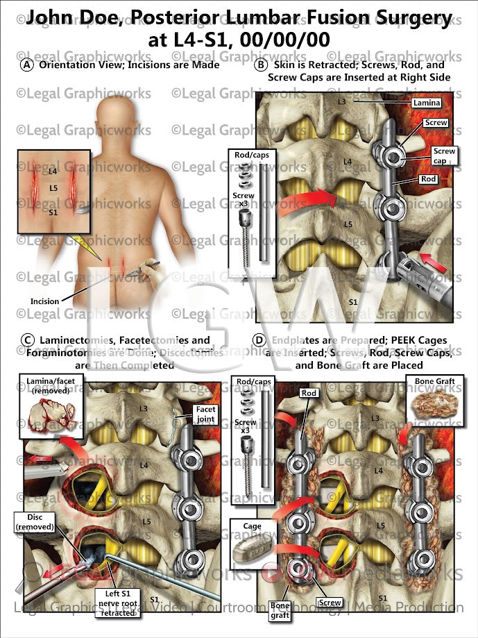 Posterior Lumbar Fusion Surgery