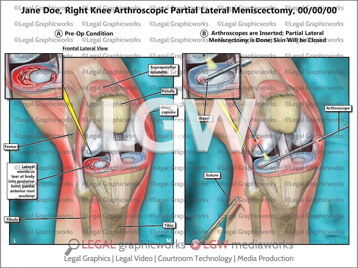 Right Knee Arthroscopic Partial Lateral Meniscectomy