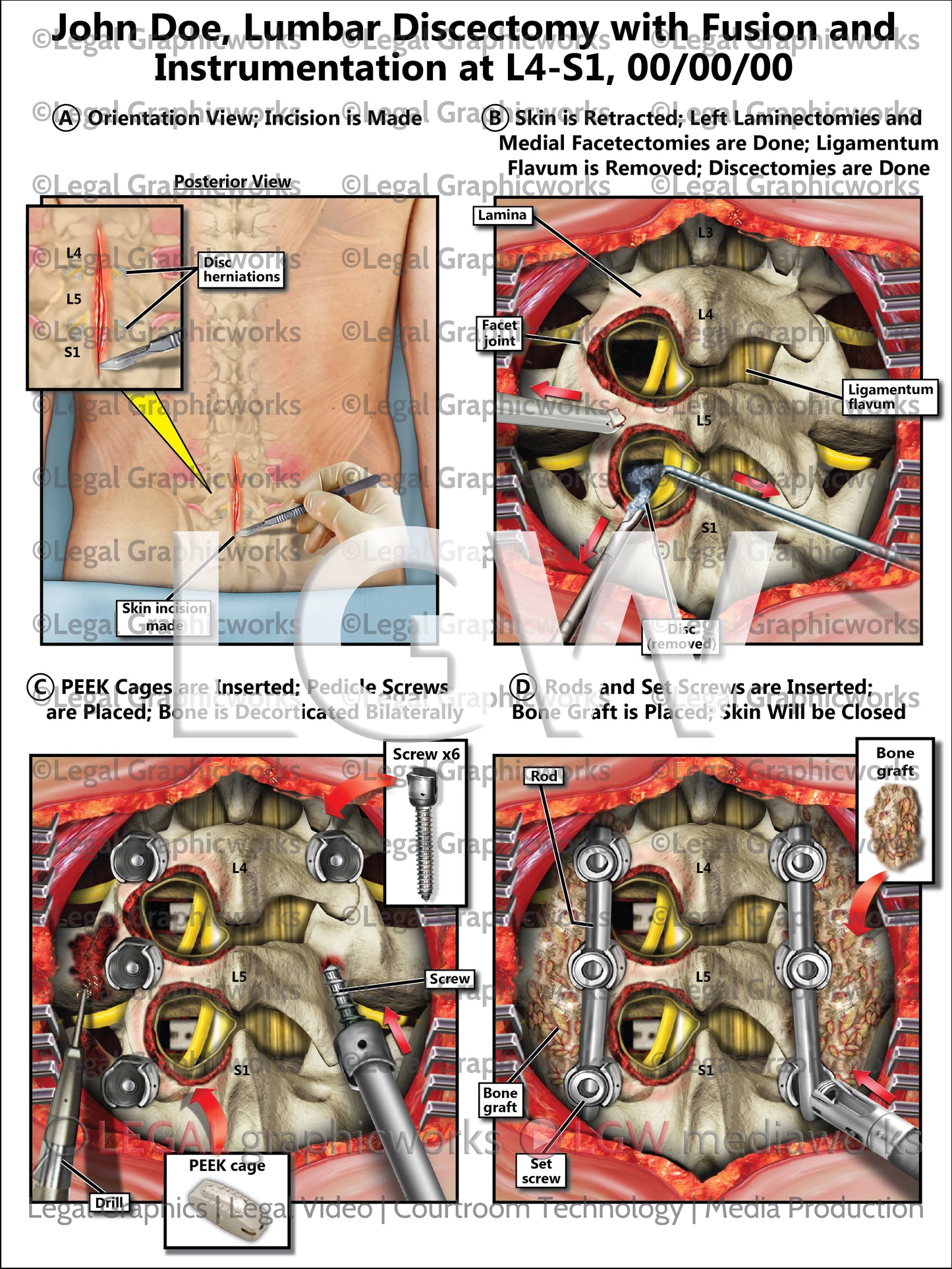 Lumbar Discectomy with Fusion and Instrumentation at L4-S1