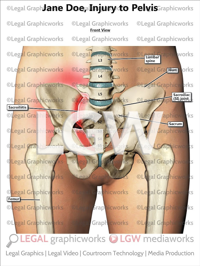 Injury to Pelvis