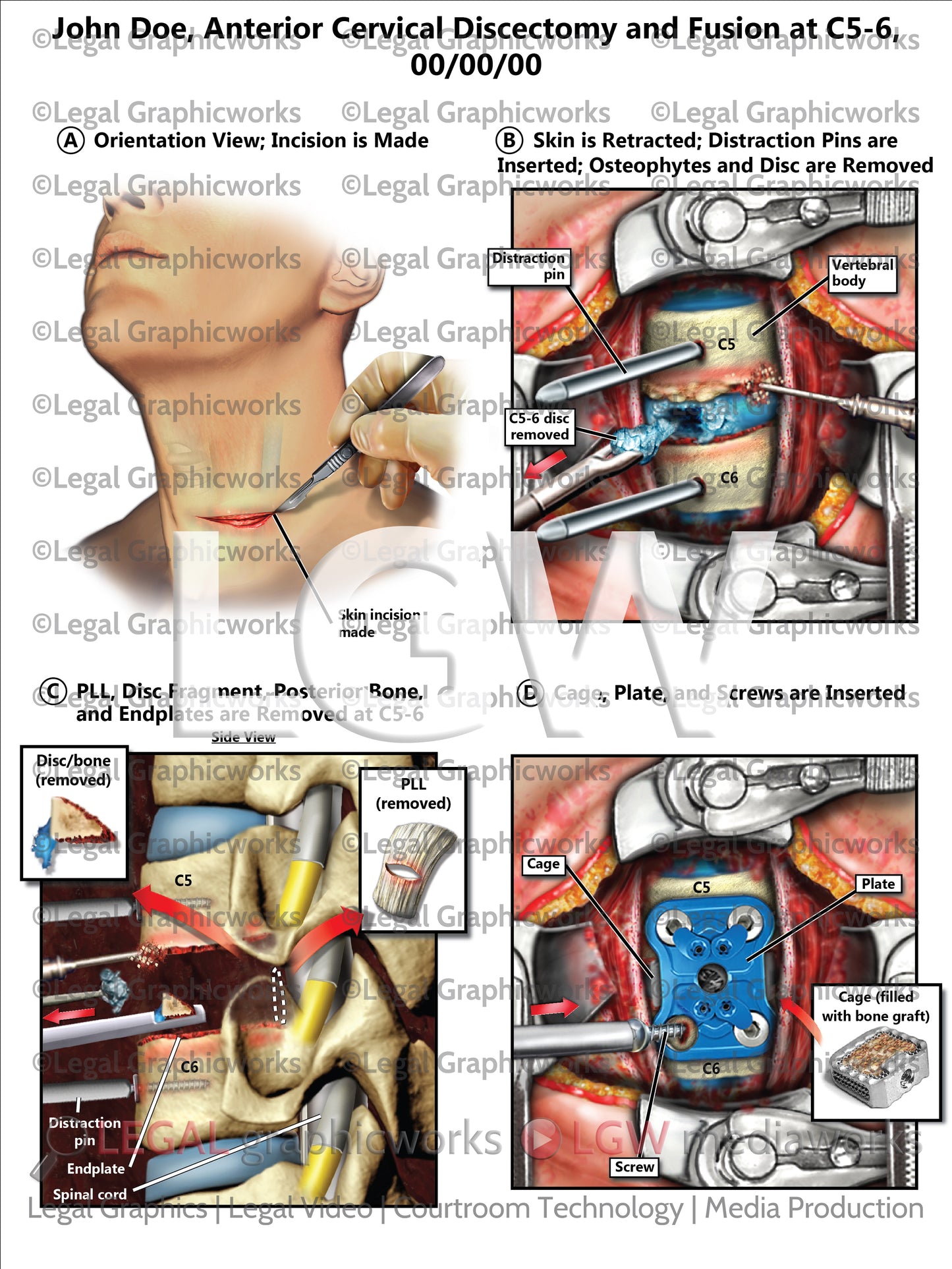 Anterior Cervical Discectomy and Fusion at C5-6