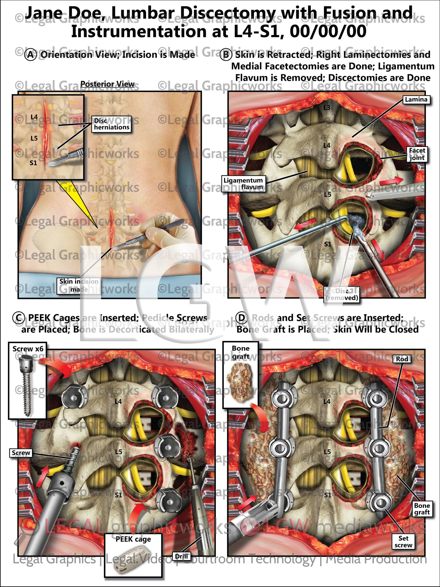 Lumbar Discectomy with Fusion and Instrumentation at L4-S1