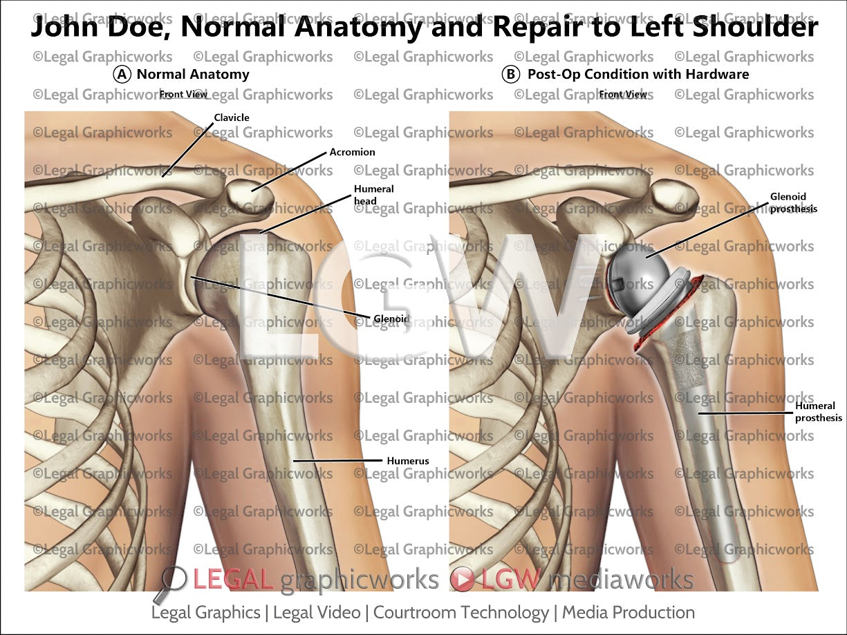 Normal Anatomy and Repair to Left Shoulder