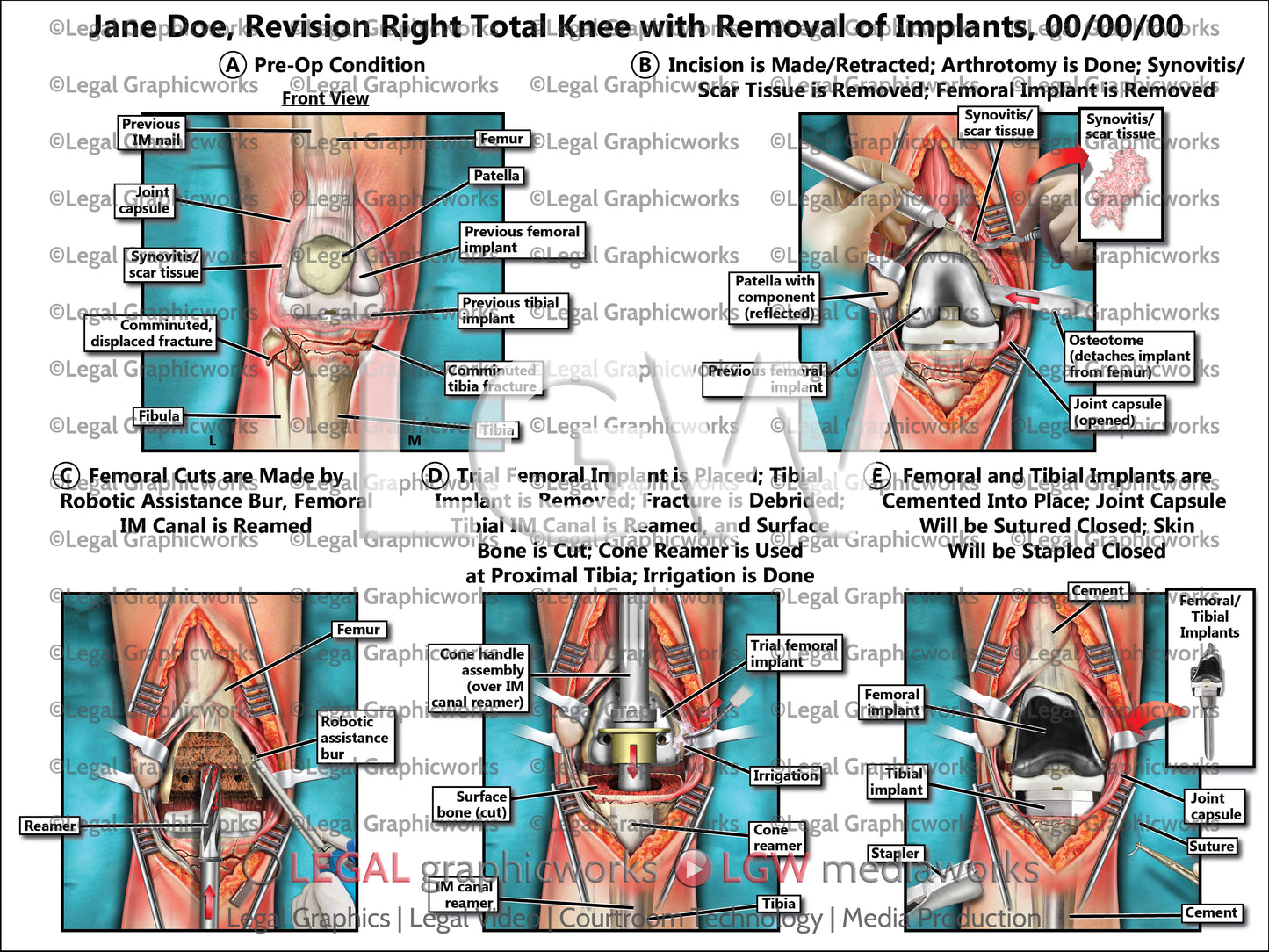 Revision Right Total Knee with Removal of Implants