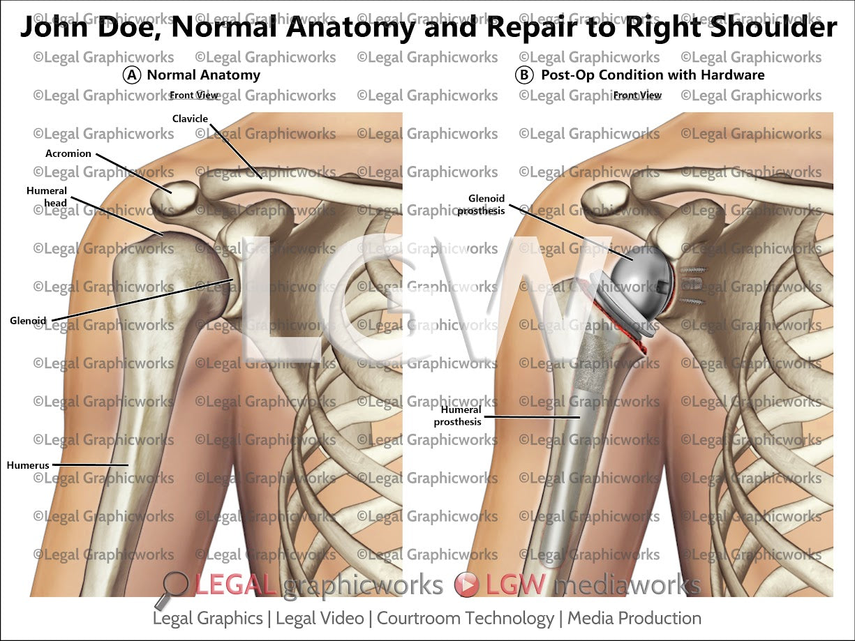 Normal Anatomy and Repair to Right Shoulder