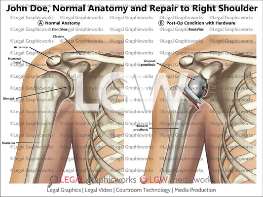 Normal Anatomy and Repair to Right Shoulder